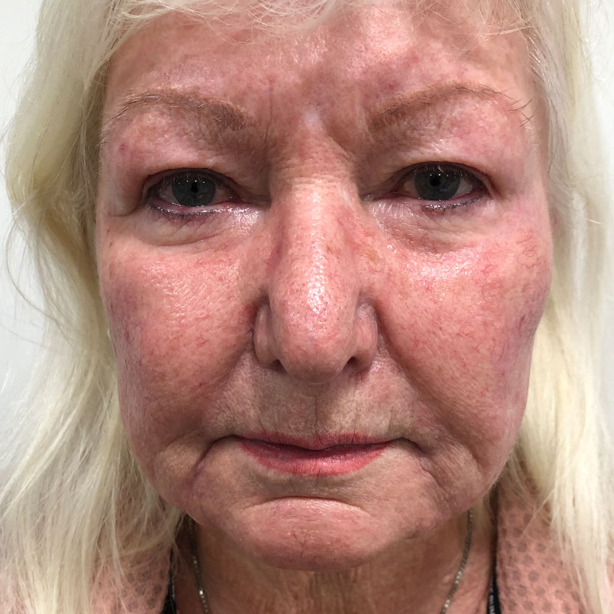 1422efter2ml+rejuvernationx1