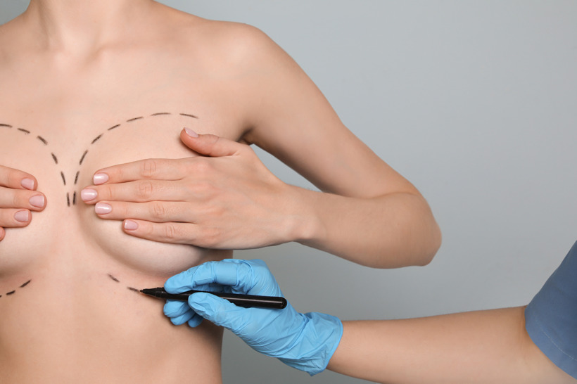 Doctor drawing marks on female breast for cosmetic surgery opera