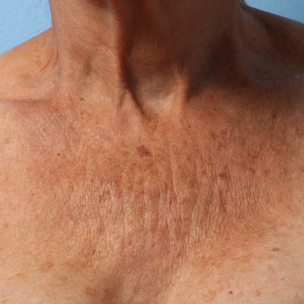 Ultherapy-003DKY_0Day_BEFORE_Chest_hi-res