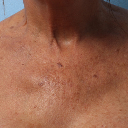 Ultherapy-003DKY_180Day_1TX_AFTER_Chest_hi-res