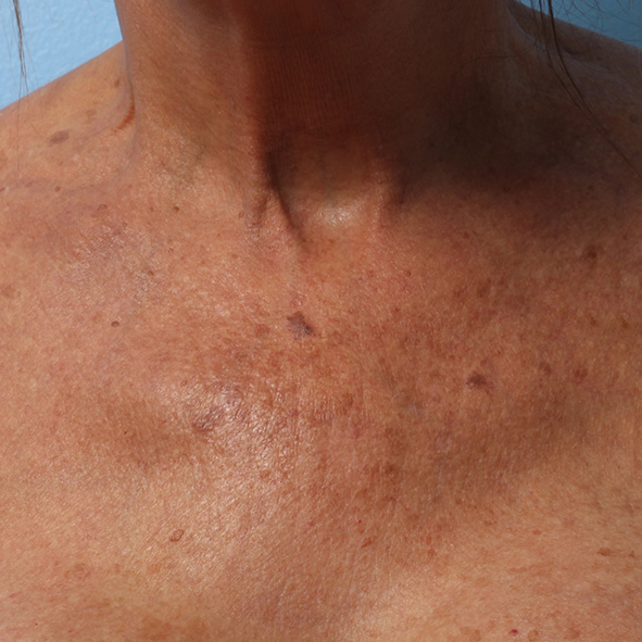 Ultherapy-003DKY_180Day_1TX_AFTER_Chest_hi-res