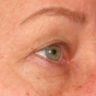 Ultherapy-EYES-AFTER