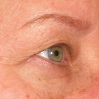 Ultherapy-EYES-BEFORE