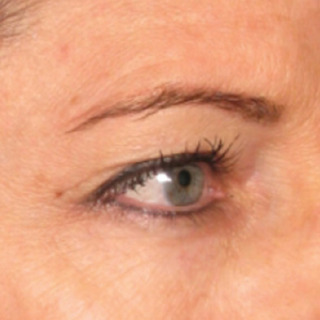 Ultherapy-EYES2-BEFORE