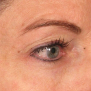 Ultherapy-EYES2-aFTER
