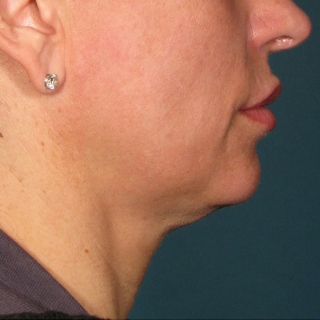 Ultherapy-Hals-BEFORE
