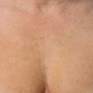 Ultherapy-bryst-AFTER