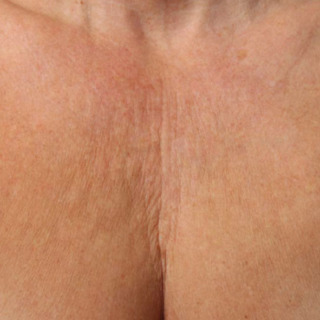 Ultherapy-bryst-BEFORE