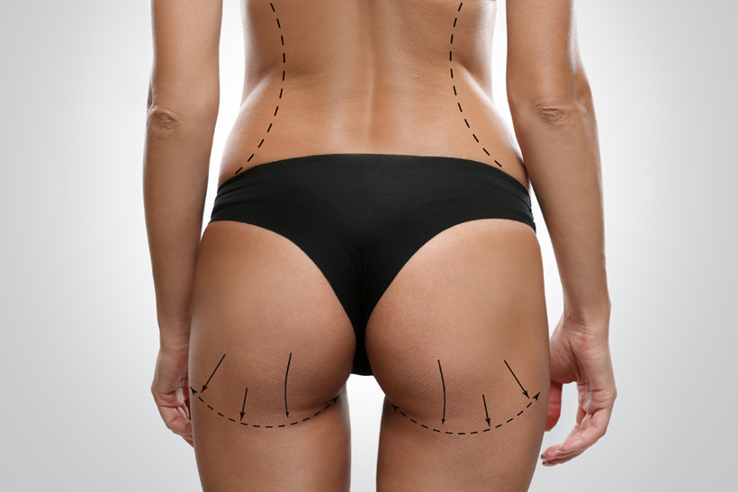 Young female body with marks for plastic operation, gray backgro