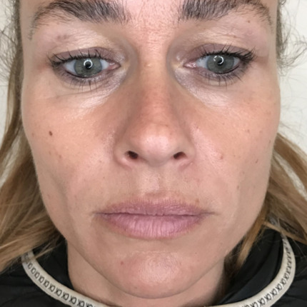 Sanne Messer - Furer næse til mund_1EFTER