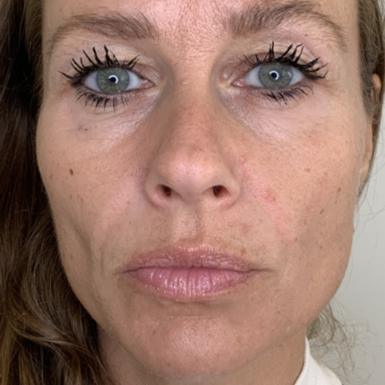 Sanne Messer - Furer næse til mund_1FØR