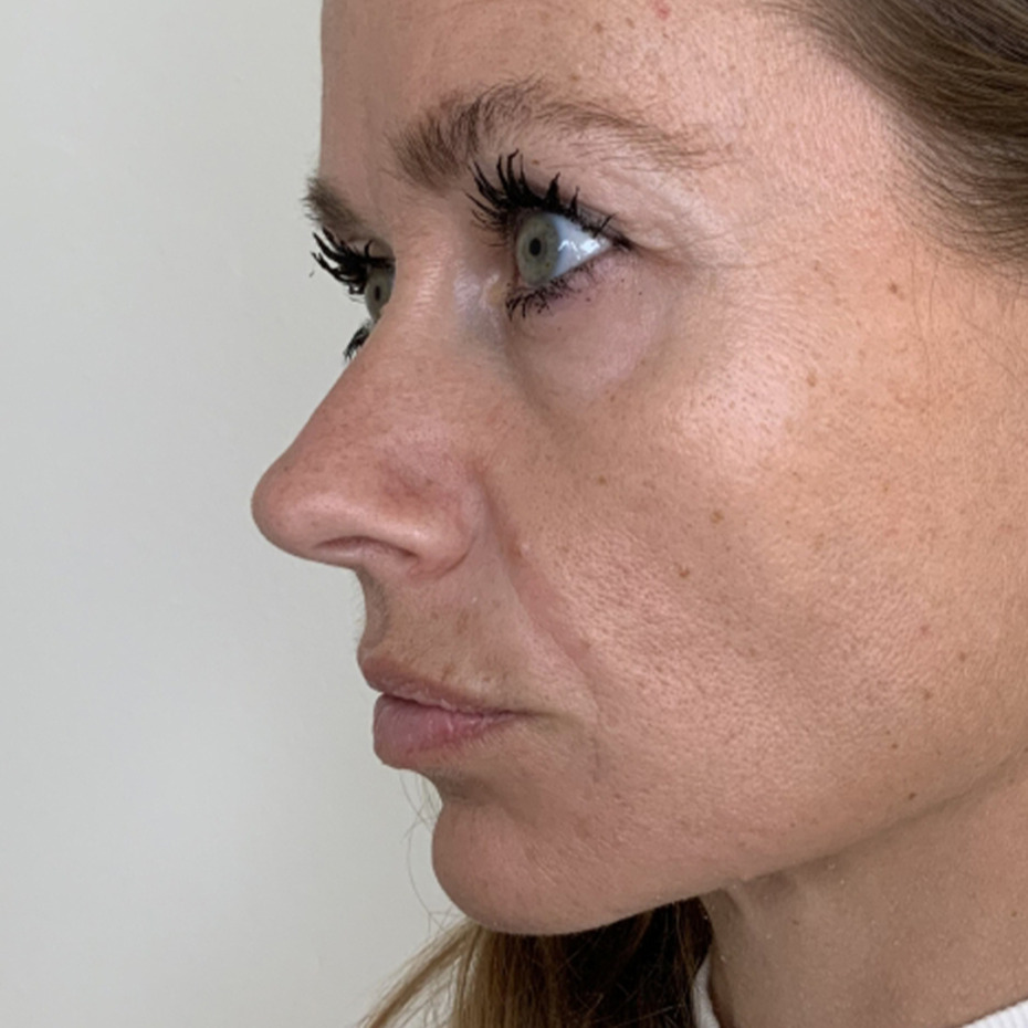 Sanne Messer - Furer næse til mund_2FØR