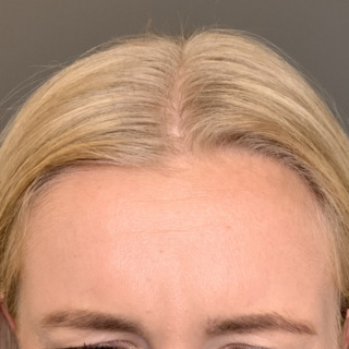Amalie_Botox_1Efter