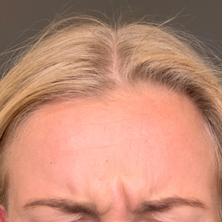 Amalie_Botox_1Før