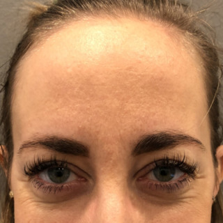 C_Glabella_3EFTER