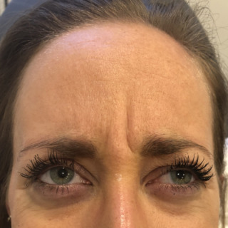 C_Glabella_3FØR
