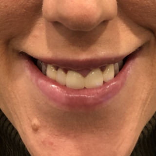 C_Gummy Smile_4EFTER