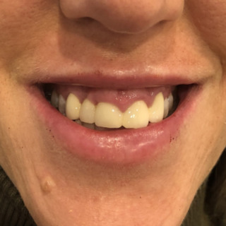 C_Gummy Smile_4FØR