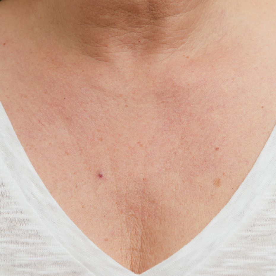 bryst_profhilo3EFTER