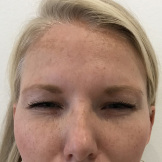 GLABELLA2EFTER