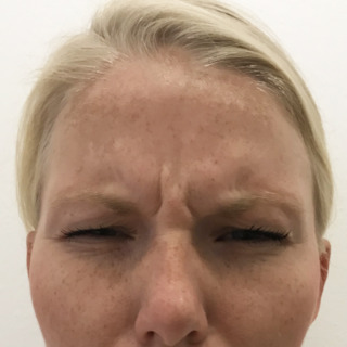 GLABELLA2FØR