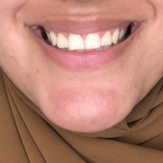 gummismile-efter-forfra