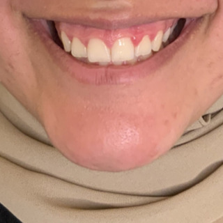 gummismile-foer-forfra