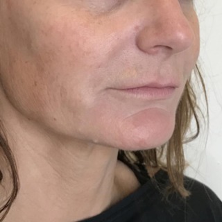 Efter-45grader-skinbooster