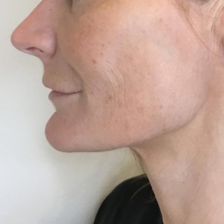 Efter-siden-skinbooster