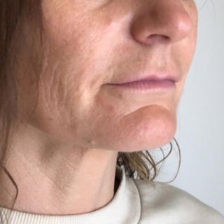 Før-45grader-skinbooster