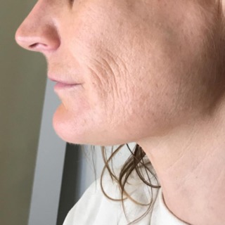 Før-siden-skinbooster