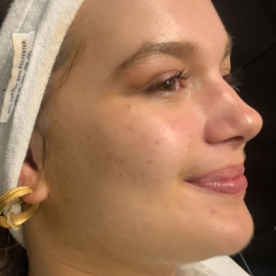 Acnelan-efter-7behandling