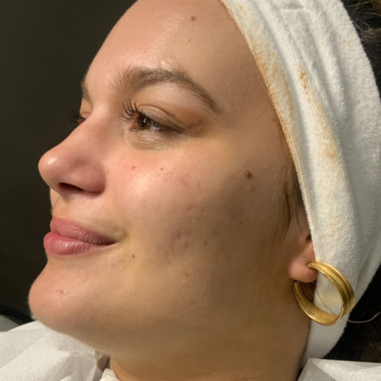 Acnelan-efter-7behandling2