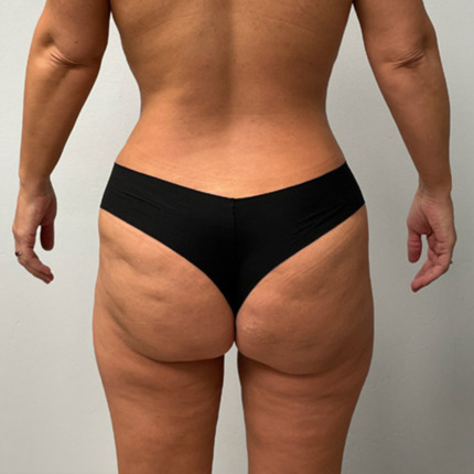 Renuvion-flanker-inderlaar-efter