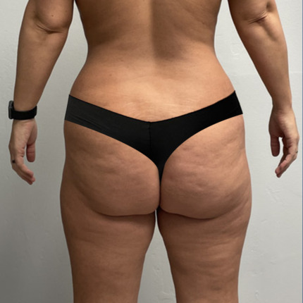 Renuvion-flanker-inderlaar-foer