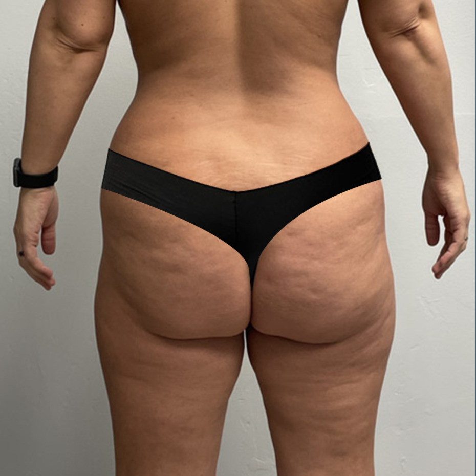 Renuvion-flanker-inderlaar-foer