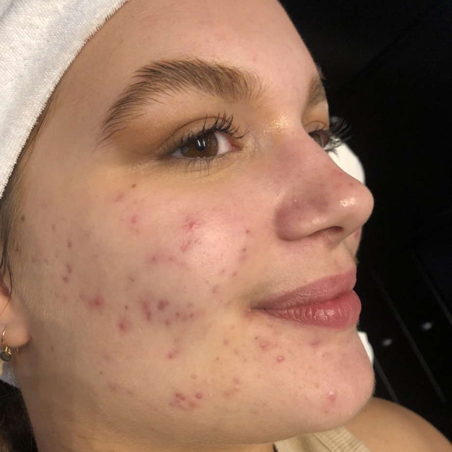 acnelan-peeling-foer1