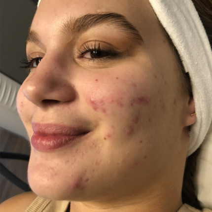 acnelan-peeling-foer2