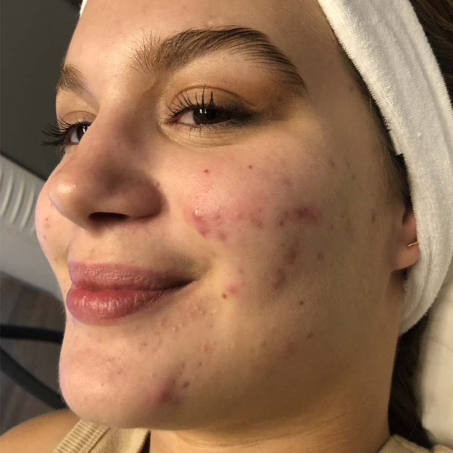 acnelan-peeling-foer2