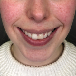 cerix-gummysmile-lipflip-efter