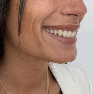 Website-gummismile-laeber-lipflip-efter3