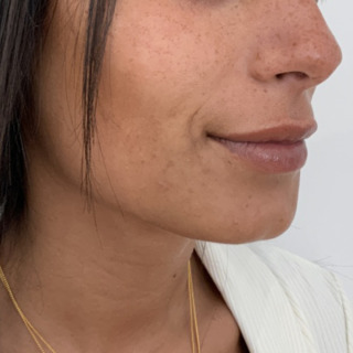 Website-gummismile-laeber-lipflip-efter4