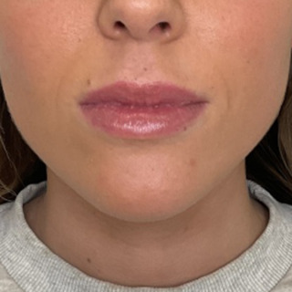 Website-laeber-lipflip-efter1