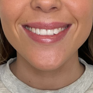 Website-laeber-lipflip-efter2
