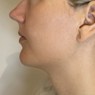 Foer-efter-softlift-kaebe-hage-web1