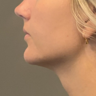Foer-efter-softlift-kaebe-hage-web2