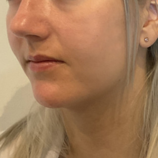 Foer-efter-softlift-kaebe-hage-web3