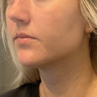 Foer-efter-softlift-kaebe-hage-web4