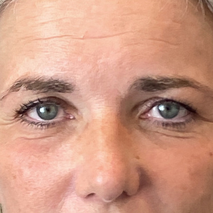 foer-efter-oejenlaagsoperation1-website