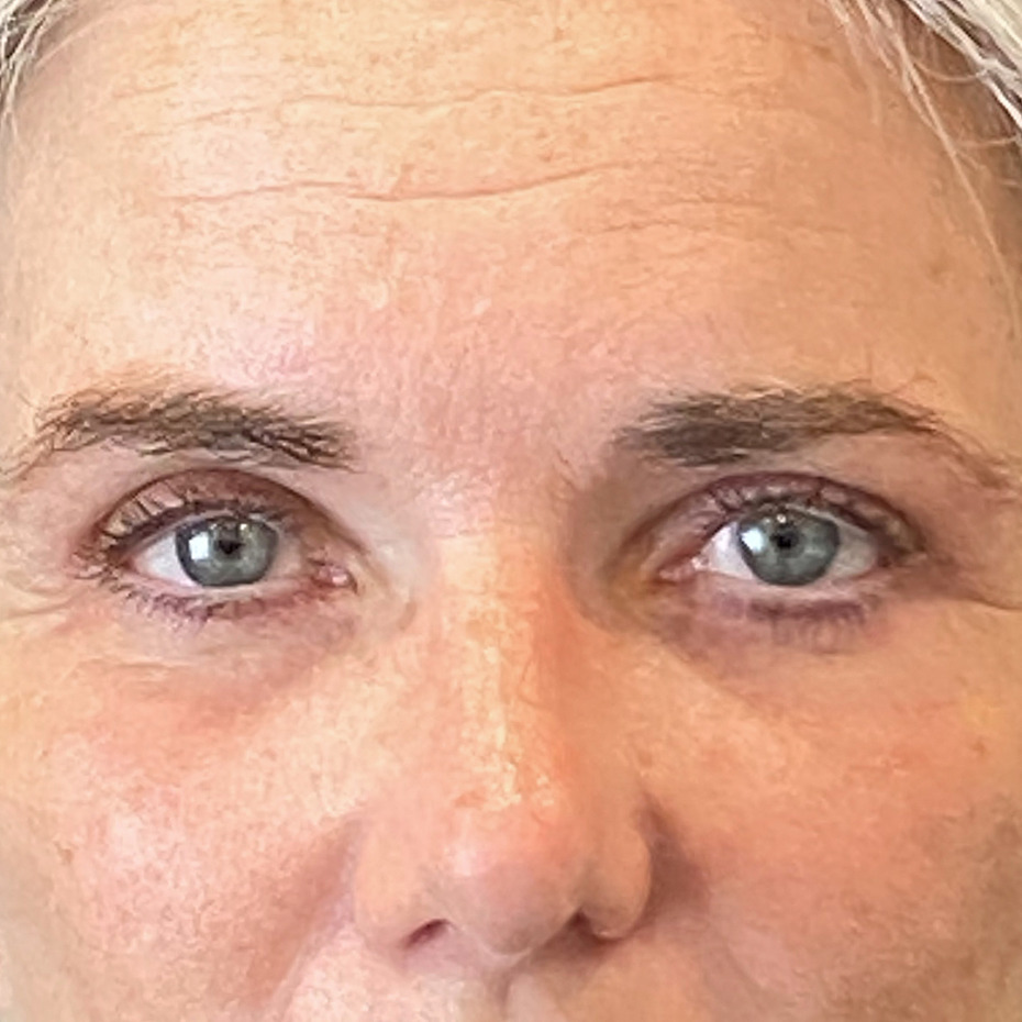 foer-efter-oejenlaagsoperation2-website